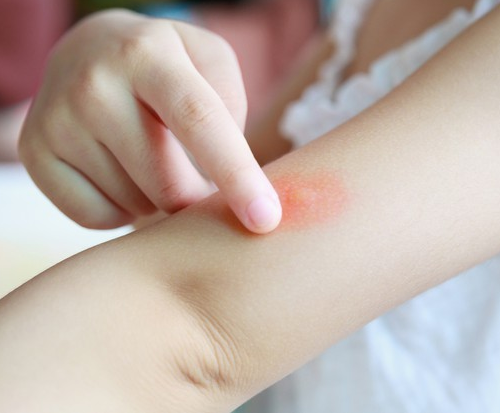 Rötungen und Irritationen